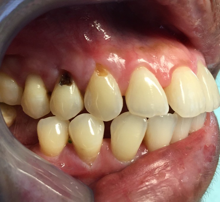 How to treat and prevent gum line cavities My BEST Dentists Journal