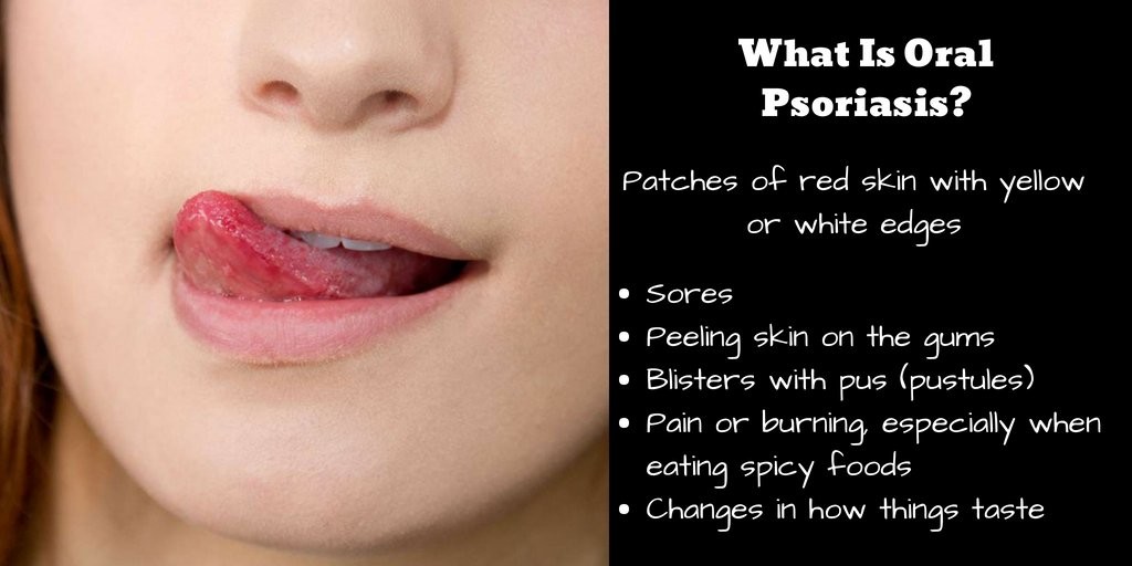 What Is Oral Psoriasis? My BEST Dentists Journal MyBestDentists