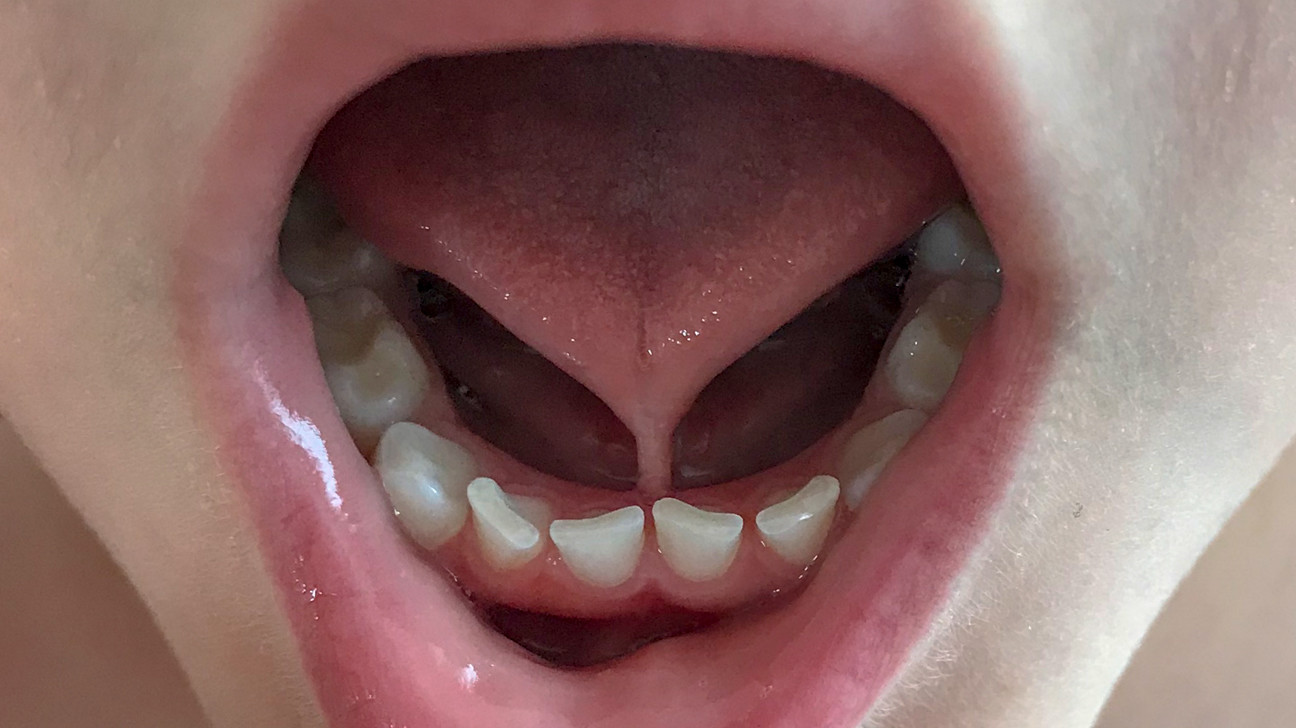 Frenulum In The Mouth My BEST Dentists Journal MyBestDentists
