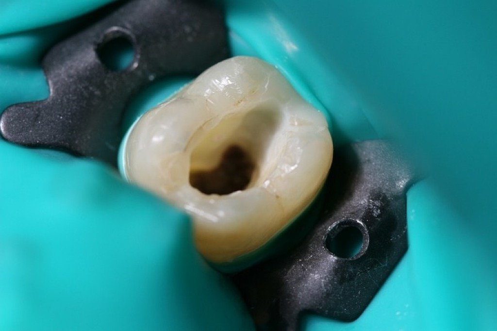 What is the rubber dam and why your dentist might use it? My BEST